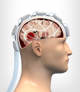 Strokefinder