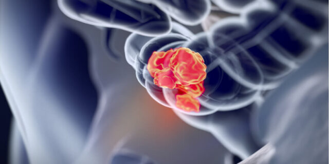 Scandion Oncology