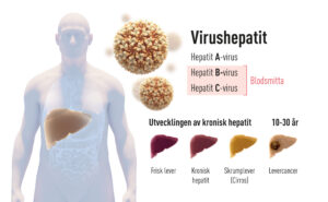 Utveckling av virushepatit