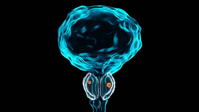 Illustration på prostatacancer